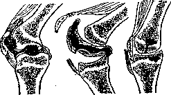 Tuberculosis: figure 15 from the 1928–1936 encyclopedia article
