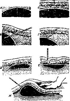 Tuberculosis: figure 14 from the 1928–1936 encyclopedia article