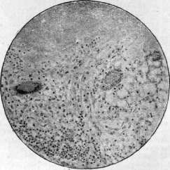 Tuberculosis: figure 7 from the 1928–1936 encyclopedia article