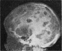 Myeloma: figure 3 from the 1928–1936 encyclopedia article