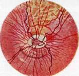 Typhus (TYPHUS): figure 10 from the 1928–1936 encyclopedia article