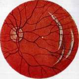 Typhus (TYPHUS): figure 8 from the 1928–1936 encyclopedia article