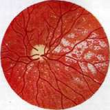 Typhus (TYPHUS): figure 7 from the 1928–1936 encyclopedia article