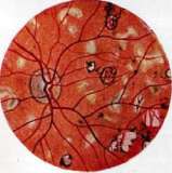 Typhus (TYPHUS): figure 9 from the 1928–1936 encyclopedia article