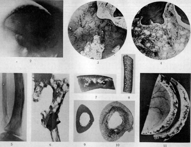 Osteitis Deformans: figure 1 from the 1928–1936 encyclopedia article