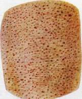 Urticaria: figure 2 from the 1928–1936 encyclopedia article