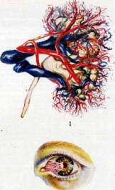 Urticaria: figure 1 from the 1928–1936 encyclopedia article