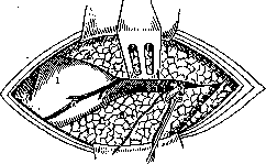 Lungs: figure 37 from the 1928–1936 encyclopedia article