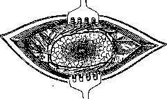 Lungs: figure 36 from the 1928–1936 encyclopedia article