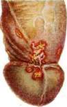 Soft Chancre: figure 5 from the 1928–1936 encyclopedia article