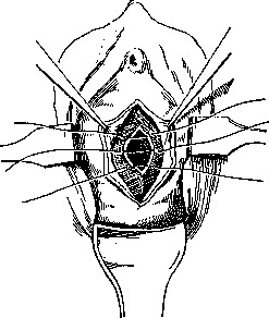 Urethra: figure 23 from the 1928–1936 encyclopedia article