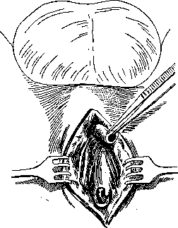 Urethra: figure 15 from the 1928–1936 encyclopedia article