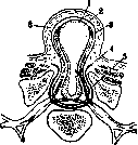 Spina Bifida: figure 8 from the 1928–1936 encyclopedia article