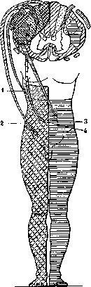 Brown-Séquard Syndrome: figure 1 from the 1928–1936 encyclopedia article