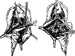 Colporrhaphy: figure 5 from the 1928–1936 encyclopedia article