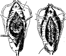 Colporrhaphy: figure 2 from the 1928–1936 encyclopedia article