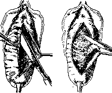 Colporrhaphy: figure 1 from the 1928–1936 encyclopedia article