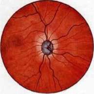 Hypernephritis: figure 1 from the 1928–1936 encyclopedia article