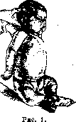 Osteochondritis: figure 1 from the 1928–1936 encyclopedia article