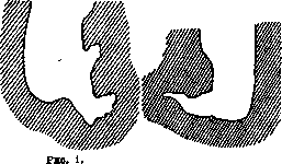 Amputation: figure 1 from the 1928–1936 encyclopedia article