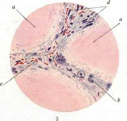 Gumma: figure 2 from the 1928–1936 encyclopedia article