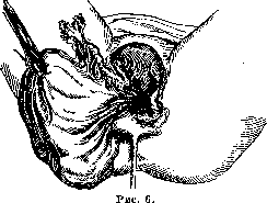 Colpotomy: figure 4 from the 1928–1936 encyclopedia article