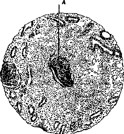 Abscess: figure 3 from the 1928–1936 encyclopedia article