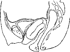 Wertheim Operation: figure 2 from the 1928–1936 encyclopedia article