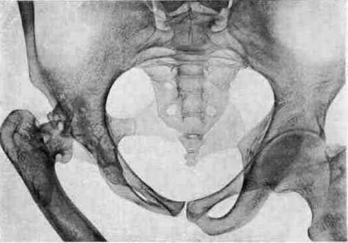 Uterine Inversion: figure 7 from the 1928–1936 encyclopedia article