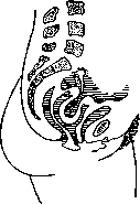 Uterine Inversion: figure 1 from the 1928–1936 encyclopedia article
