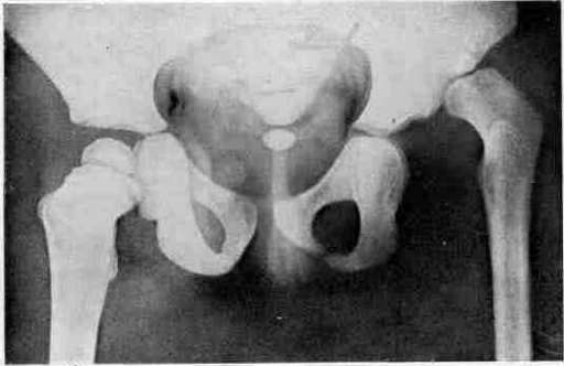 Uterine Inversion: figure 6 from the 1928–1936 encyclopedia article