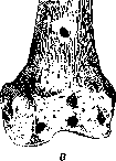Fractures: figure 2 from the 1928–1936 encyclopedia article