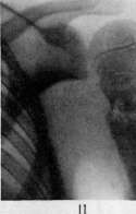 Fractures: figure 13 from the 1928–1936 encyclopedia article