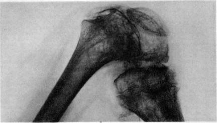 Ankylosis: figure 4 from the 1928–1936 encyclopedia article