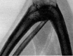 Ankylosis: figure 5 from the 1928–1936 encyclopedia article