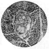 Diabetes Mellitus: figure 4 from the 1928–1936 encyclopedia article
