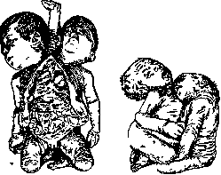 Malformations: figure 4 from the 1928–1936 encyclopedia article