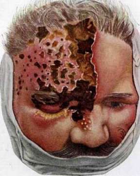 Herpes: figure 1 from the 1928–1936 encyclopedia article