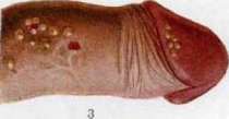 Herpes: figure 3 from the 1928–1936 encyclopedia article