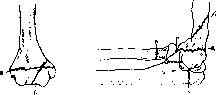 Elbow Joint: figure 15 from the 1928–1936 encyclopedia article