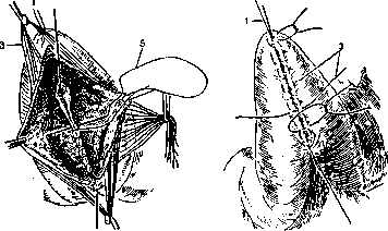 Gastroduodenostomy: figure 3 from the 1928–1936 encyclopedia article
