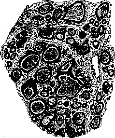 Graves' Disease: figure 3 from the 1928–1936 encyclopedia article