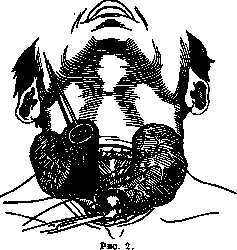 Graves' Disease: figure 8 from the 1928–1936 encyclopedia article