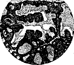Graves' Disease: figure 4 from the 1928–1936 encyclopedia article