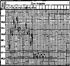 Pneumonia: figure 9 from the 1928–1936 encyclopedia article