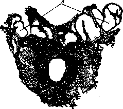Vesiculitis: figure 2 from the 1928–1936 encyclopedia article