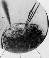 Microsurgery: figure 5 from the 1928–1936 encyclopedia article