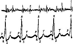 Heart Defects: figure 5 from the 1928–1936 encyclopedia article
