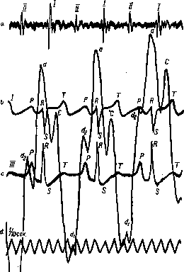 Heart Defects: figure 7 from the 1928–1936 encyclopedia article