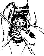Vaginal Hysterotomy: figure 1 from the 1928–1936 encyclopedia article